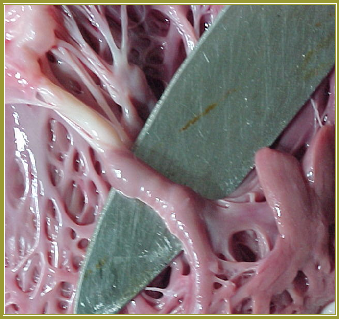Imagen No. 5 - Fibrosis de la cuerda. Fusión y torsión de músculos papilares.